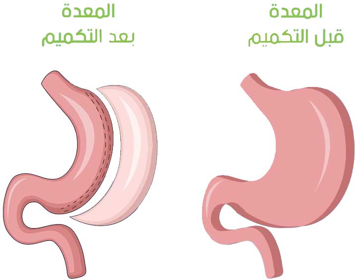 The process of toning the stomach in Turkey 